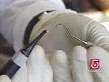 Dental Laser
