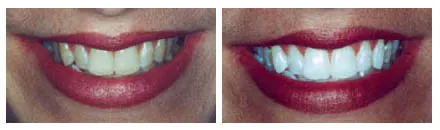 Zoom Teeth Whitening