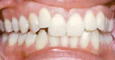 Braces - Orthodontics
