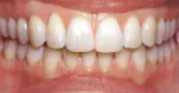 Braces - Orthodontics