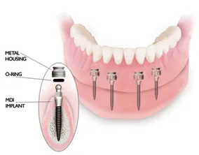 Diagram of dental implants in the lower jaw